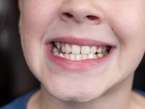 dentes tortos