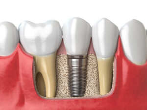 implantes dentários