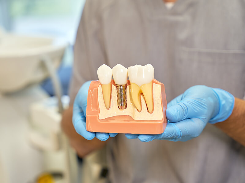 implantes dentários