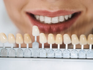 lentes de contato dental