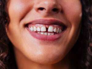 lentes de contato dental